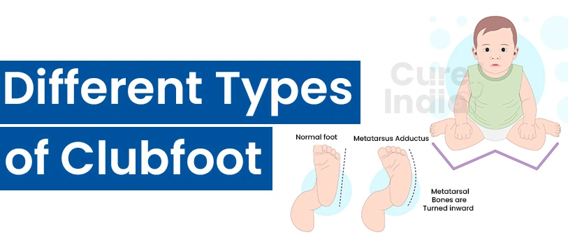 Types of Clubfoot
